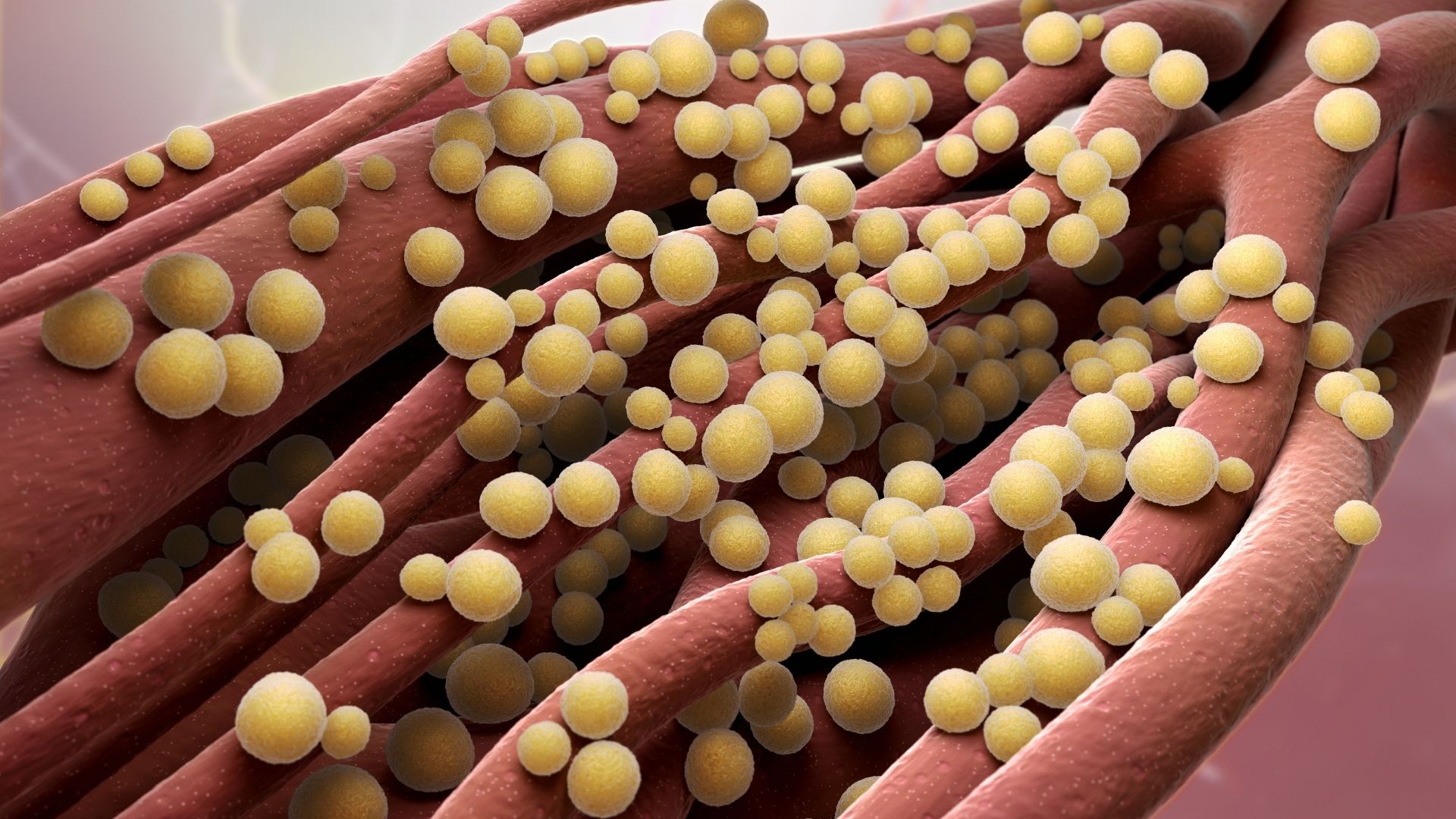 Sepsis
